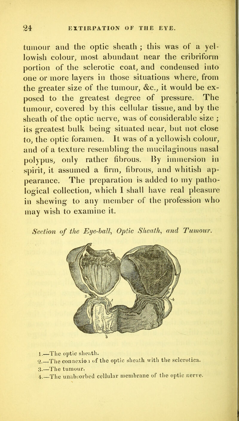 tumour and the optic sheath ; this was of a yel- lowish colour^ most abundant near the cribriform portion of the sclerotic coab and condensed into one or more layers in those situations where^ from the greater size of the tumour^ &c._, it would be ex- posed to the greatest degree of pressure. The tumour, covered by this cellular tissue, and by the sheath of the optic nerve, was of considerable size ; its greatest bulk being situated near, but not close to, the optic foramen. It was of a yellowish colour, and of a texture resembling the mucilaginous nasal polypus, only rather fibrous. By immersion in spirit, it assumed a firm, fibrous, and whitish ap- pearance. The preparation is added to my patho- logical collection, which I shall have real pleasure in shewing to any member of the profession who may wish to examine it. Section of the Eye-half Optic Sheath^ and Tumour. 1. —The optic sheath. 2. The connexio 1 of the optic sheath with the sclerotica. 3. —The tumour. 4. _Xhe unabsorhed cellular membrane of the optic nerve.