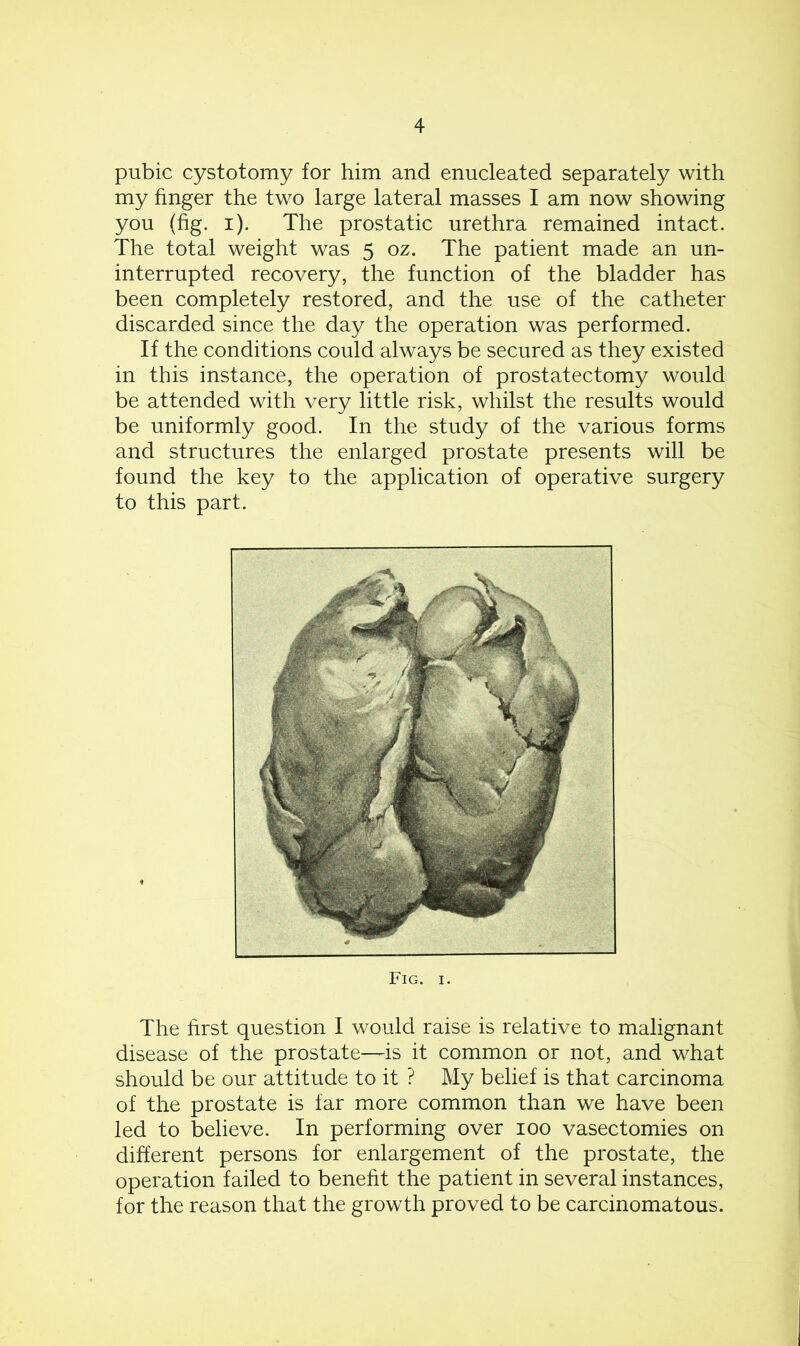 pubic cystotomy for him and enucleated separately with my finger the two large lateral masses I am now showing you (fig. i). The prostatic urethra remained intact. The total weight was 5 oz. The patient made an un- interrupted recovery, the function of the bladder has been completely restored, and the use of the catheter discarded since the day the operation was performed. If the conditions could always be secured as they existed in this instance, the operation of prostatectomy would be attended with very little risk, whilst the results would be uniformly good. In the study of the various forms and structures the enlarged prostate presents will be found the key to the application of operative surgery to this part. The first question I would raise is relative to malignant disease of the prostate—is it common or not, and what should be our attitude to it ? My belief is that carcinoma of the prostate is far more common than we have been led to believe. In performing over 100 vasectomies on different persons for enlargement of the prostate, the operation failed to benefit the patient in several instances, for the reason that the growth proved to be carcinomatous. Fig. 1.