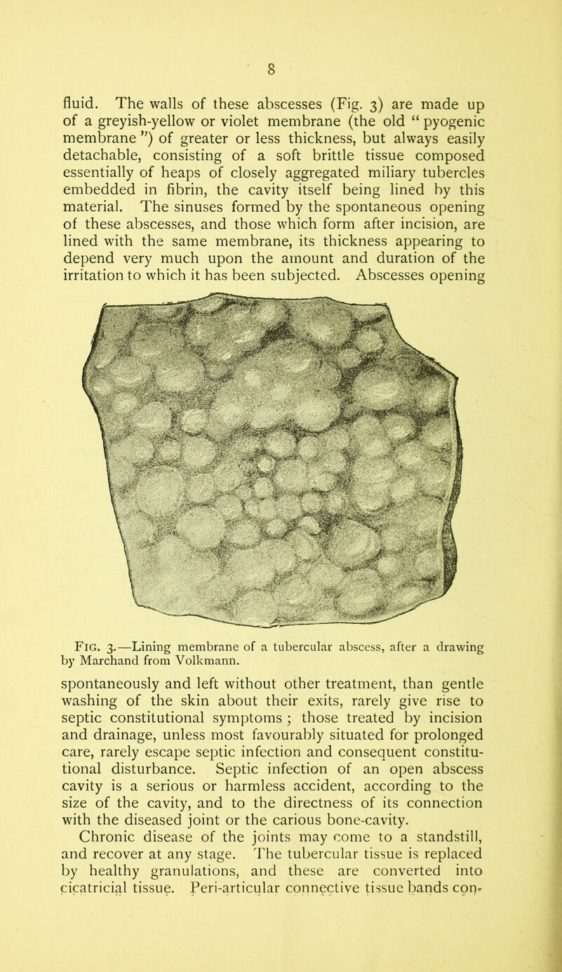 fluid. The walls of these abscesses (Fig. 3) are made up of a greyish-yellow or violet membrane (the old “ pyogenic membrane ”) of greater or less thickness, but always easily detachable, consisting of a soft brittle tissue composed essentially of heaps of closely aggregated miliary tubercles embedded in fibrin, the cavity itself being lined by this material. The sinuses formed by the spontaneous opening of these abscesses, and those which form after incision, are lined with the same membrane, its thickness appearing to depend very much upon the amount and duration of the irritation to which it has been subjected. Abscesses opening Fig. 3.—Lining membrane of a tubercular abscess, after a drawing by Marchand from Volkmann. spontaneously and left without other treatment, than gentle washing of the skin about their exits, rarely give rise to septic constitutional symptoms ; those treated by incision and drainage, unless most favourably situated for prolonged care, rarely escape septic infection and consequent constitu- tional disturbance. Septic infection of an open abscess cavity is a serious or harmless accident, according to the size of the cavity, and to the directness of its connection with the diseased joint or the carious bone-cavity. Chronic disease of the joints may come to a standstill, and recover at any stage. The tubercular tissue is replaced by healthy granulations, and these are converted into cicatricial tissue. Peri-articular connective tissue bands con-