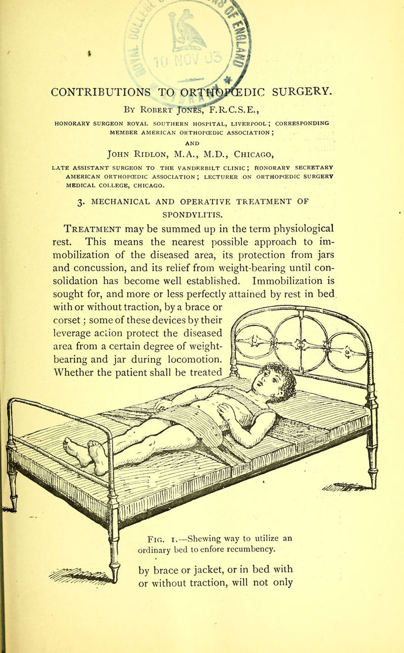 HONORARY SURGEON ROYAL SOUTHERN HOSPITAL, LIVERPOOL ; CORRESPONDING MEMBER AMERICAN ORTHOrCEDIC ASSOCIATION ; AND John Ridlon, M.A., M.D., Chicago, LATE ASSISTANT SURGEON TO THE VANDERBILT CLINIC J HONORARY SECRETARY AMERICAN ORTHOPCEDIC ASSOCIATION ; LECTURER ON ORTHOPCEDIC SURGERY MEDICAL COLLEGE, CHICAGO. 3. MECHANICAL AND OPERATIVE TREATMENT OF SPONDYLITIS. Treatment may be summed up in the term physiological rest. This means the nearest possible approach to im- mobilization of the diseased area, its protection from jars and concussion, and its relief from weight-bearing until con- solidation has become well established. Immobilization is sought for, and more or less perfectly attained by rest in bed
