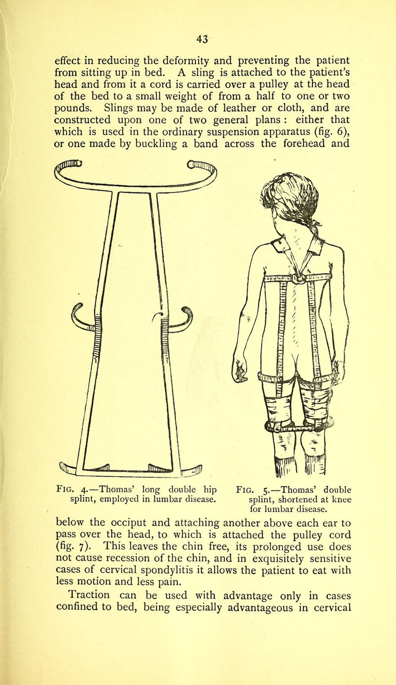 effect in reducing the deformity and preventing the patient from sitting up in bed. A sling is attached to the patient’s head and from it a cord is carried over a pulley at the head of the bed to a small weight of from a half to one or two pounds. Slings may be made of leather or cloth, and are constructed upon one of two general plans : either that which is used in the ordinary suspension apparatus (fig. 6), or one made by buckling a band across the forehead and Fig. 4.—Thomas’ long double hip splint, employed in lumbar disease. Fig. 5.—Thomas’ double splint, shortened at knee for lumbar disease. below the occiput and attaching another above each ear to pass over the head, to which is attached the pulley cord (fig. 7). This leaves the chin free, its prolonged use does not cause recession of the chin, and in exquisitely sensitive cases of cervical spondylitis it allows the patient to eat with less motion and less pain. Traction can be used with advantage only in cases confined to bed, being especially advantageous in cervical