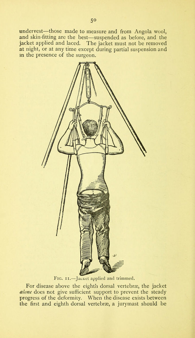 5° undervest—those made to measure and from Angola wool, and skin-fitting are the best—suspended as before, and the jacket applied and laced. The jacket must not be removed at night, or at any time except during partial suspension and in the presence of the surgeon. For disease above the eighth dorsal vertebrae, the jacket alone does not give sufficient support to prevent the steady progress of the deformity. When the disease exists between the first and eighth dorsal vertebrae, a jurymast should be