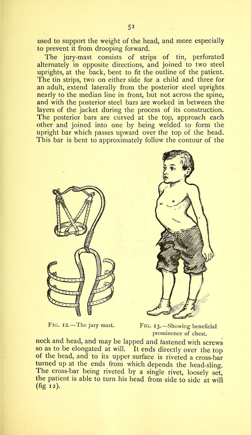 used to support the weight of the head, and more especially to prevent it from drooping forward. The jury-mast consists of strips of tin, perforated alternately in opposite directions, and joined to two steel uprights, at the back, bent to fit the outline of the patient. The tin strips, two on either side for a child and three for an adult, extend laterally from the posterior steel uprights nearly to the median line in front, but not across the spine, and with the posterior steel bars are worked in between the layers of the jacket during the process of its construction. The posterior bars are curved at the top, approach each other and joined into one by being welded to form the upright bar which passes upward over the top of the head. This bar is bent to approximately follow the contour of the Fig. 12.—The jury mast. Fig. 13.—Showing beneficial prominence of chest. neck and head, and may be lapped and fastened with screws so as to be elongated at will. It ends directly over the top of the head, and to its upper surface is riveted a cross-bar turned up at the ends from which depends the head-sling. The cross-bar being riveted by a single rivet, loosely set, the patient is able to turn his head from side to side at will (fig 12).