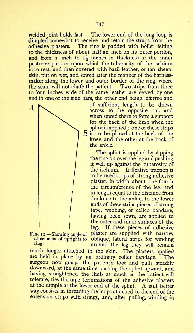 welded joint holds fast. The lower end of the long loop is dimpled somewhat to receive and retain the straps from the adhesive plasters. The ring is padded with boiler felting to the thickness of about half an inch on its outer portion, and from i inch to ij inches in thickness at the inner posterior portion upon which the tuberosity of the ischium is to rest, and then covered with basil leather, or tan sheep- skin, put on wet, and sewed after the manner of the harness- maker along the lower and outer border of the ring, where the seam will not chafe the patient. Two strips from three to four inches wide of the same leather are sewed by one end to one of the side bars, the other end being left free and of sufficient length to be drawn across to the opposite bar, and when sewed there to form a support for the back of the limb when the splint is applied; one of these strips B is to bo placed at the back of the knee and the other at the back of the ankle. The splint is applied by slipping the ring on over the leg and pushing it well up against the tuberosity of the ischium. If fixative traction is to be used strips of strong adhesive plaster, in width about one fourth the circumference of the leg, and in length equal to the distance from the knee to the ankle, to the lower ends of these strips pieces of strong, tape, webbing, or calico bandage, having been sewn, are applied to the outer and inner surfaces of the leg. If these pieces of adhesive Fig. II.—Showing angle of plaster are supplied with narrow, attachment of uprights to oblique, lateral strips for winding rin&* around the leg they will remain, much longer attached to the skin. The plasters applied are held in place by an ordinary roller bandage. The surgeon now grasps the patient’s foot and pulls steadily downward, at the same time pushing the splint upward, and having straightened the limb as much as the patient will tolerate, ties the tape terminations of the adhesive plasters at the dimple at the lower end of the splint. A still better way consists in threading the loops attached to the end of the extension strips with strings, and, after pulling, winding in