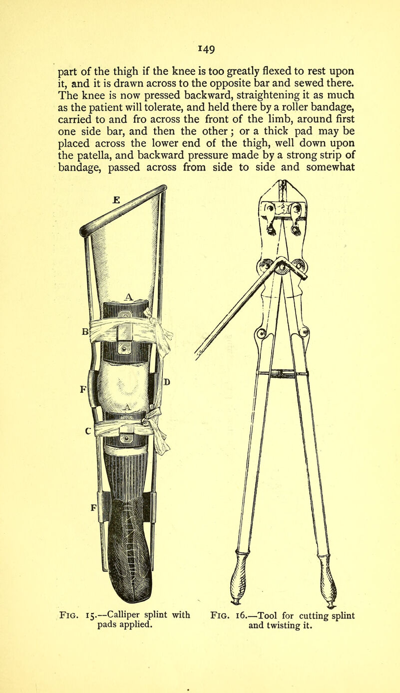 part of the thigh if the knee is too greatly flexed to rest upon it, and it is drawn across to the opposite bar and sewed there. The knee is now pressed backward, straightening it as much as the patient will tolerate, and held there by a roller bandage, carried to and fro across the front of the limb, around first one side bar, and then the other; or a thick pad may be placed across the lower end of the thigh, well down upon the patella, and backward pressure made by a strong strip of bandage, passed across from side to side and somewhat Fig. 15*—Calliper splint with Fig. 16—Tool for cutting splint pads applied. and twisting it.