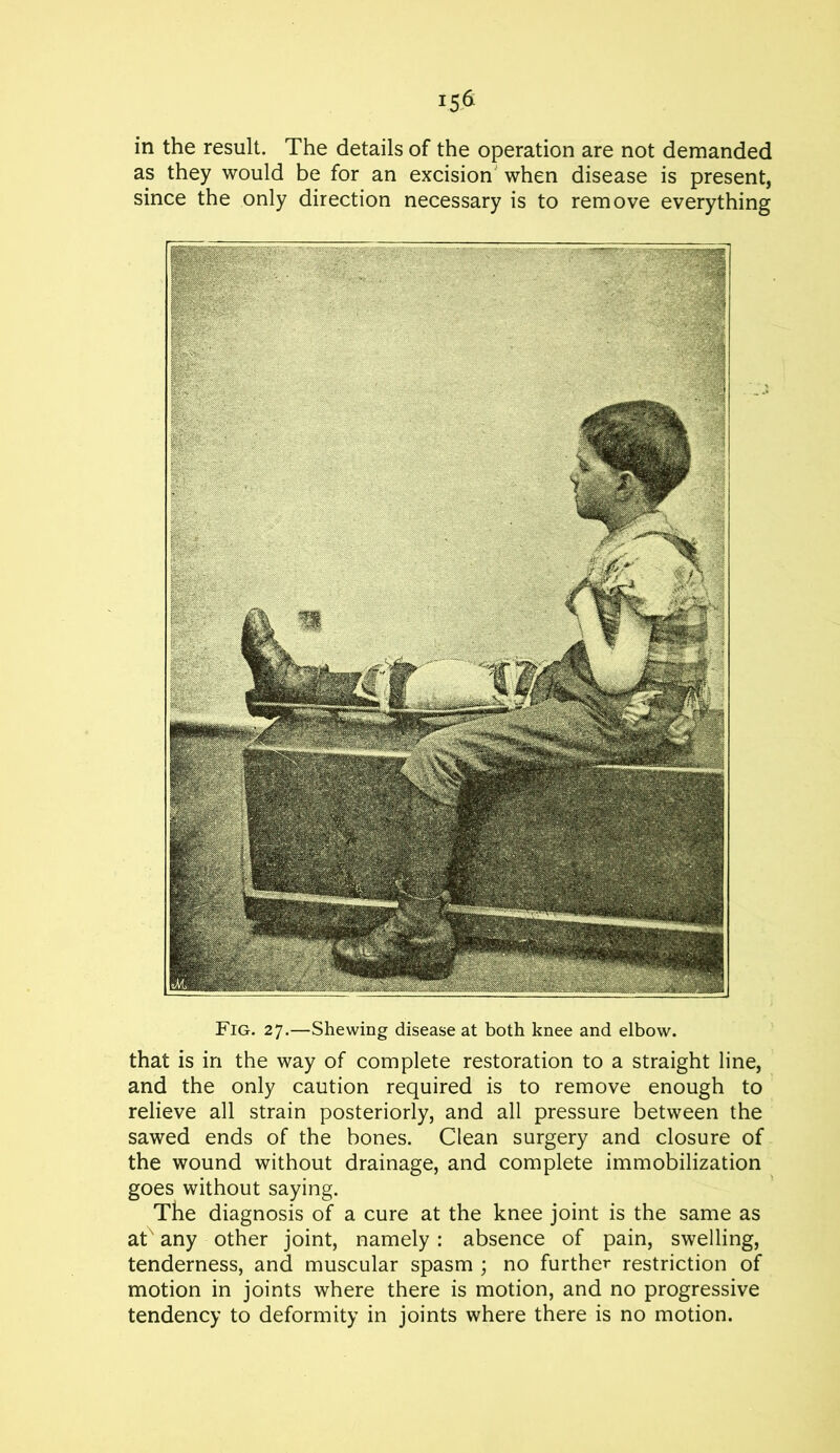 isfi in the result. The details of the operation are not demanded as they would be for an excision when disease is present, since the only direction necessary is to remove everything Fig. 27.—Shewing disease at both knee and elbow, that is in the way of complete restoration to a straight line, and the only caution required is to remove enough to relieve all strain posteriorly, and all pressure between the sawed ends of the bones. Clean surgery and closure of the wound without drainage, and complete immobilization goes without saying. The diagnosis of a cure at the knee joint is the same as at' any other joint, namely : absence of pain, swelling, tenderness, and muscular spasm ; no further restriction of motion in joints where there is motion, and no progressive tendency to deformity in joints where there is no motion.