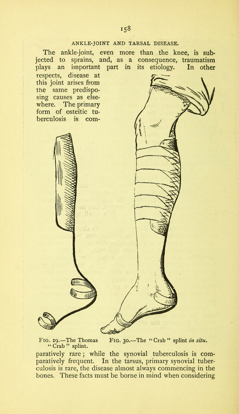 ANKLE-JOINT AND TARSAL DISEASE. The ankle-joint, even more than the knee, is sub- jected to sprains, and, as a consequence, traumatism plays an important part in its etiology. In other paratively rare; while the synovial tuberculosis is com- paratively frequent. In the tarsus, primary synovial tuber- culosis is rare, the disease almost always commencing in the bones. These facts must be borne in mind when considering