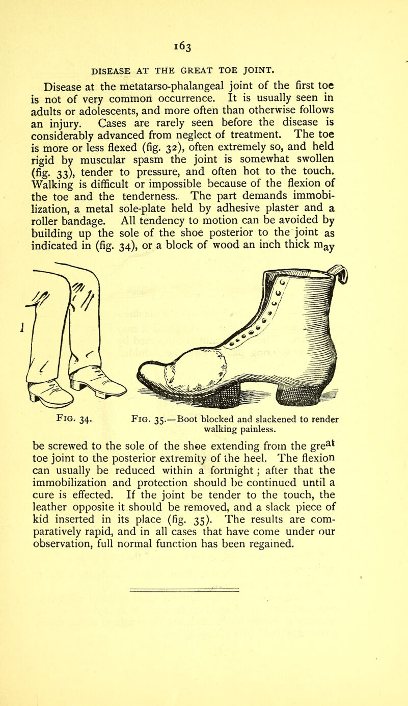 DISEASE AT THE GREAT TOE JOINT. Disease at the metatarso-phalangeal joint of the first toe is not of very common occurrence. It is usually seen in adults or adolescents, and more often than otherwise follows an injury. Cases are rarely seen before the disease is considerably advanced from neglect of treatment. The toe is more or less flexed (fig. 32), often extremely so, and held rigid by muscular spasm the joint is somewhat swollen (fig. 33), tender to pressure, and often hot to the touch. Walking is difficult or impossible because of the flexion of the toe and the tenderness.. The part demands immobi- lization, a metal sole-plate held by adhesive plaster and a roller bandage. All tendency to motion can be avoided by building up the sole of the shoe posterior to the joint as indicated in (fig. 34), or a block of wood an inch thick may walking painless. be screwed to the sole of the shoe extending from the grea* toe joint to the posterior extremity of the heel. The flexion can usually be reduced within a fortnight; after that the immobilization and protection should be continued until a cure is effected. If the joint be tender to the touch, the leather opposite it should be removed, and a slack piece of kid inserted in its place (fig. 35). The results are com- paratively rapid, and in all cases that have come under our observation, full normal function has been regained.