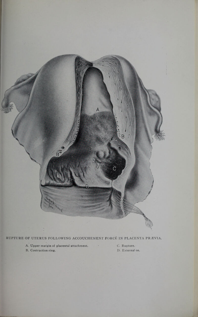 RUPTURE OF UTERUS FOLLOWING ACCOUCHEMENT FORCE IN PLACENTA PRH2VIA. A. Upper margin of placental attachment. • C. Rupture. B. Contraction ring. D. External os.