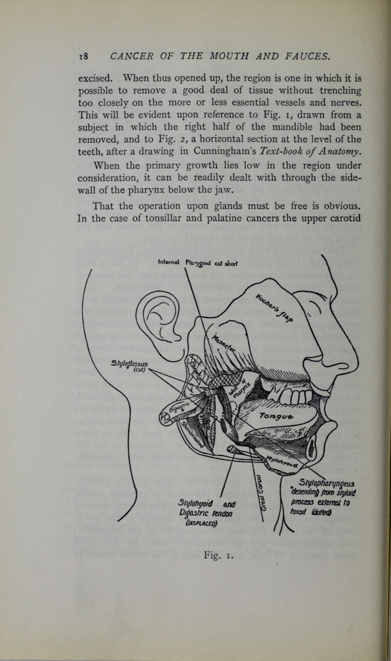 excised. When thus opened up, the region is one in which it is possible to remove a good deal of tissue without trenching too closely on the more or less essential vessels and nerves. This will be evident upon reference to Fig. i, drawn from a subject in which the right half of the mandible had been removed, and to Fig. 2, a horizontal section at the level of the teeth, after a drawing in Cunningham’s Text-hook of Anatomy, When the primary growth lies low in the region under consideration, it can be readily dealt with through the side- wall of the pharynx below the jaw. That the operation upon glands must be free is obvious. In the case of tonsillar and palatine cancers the upper carotid Fig. I.