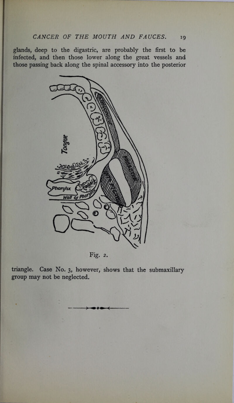 glands, deep to the digastric, are probably the first to be infected, and then those lower along the great vessels and those passing back along the spinal accessory into the posterior triangle. Case No. 3, however, shows that the submaxillary group may not be neglected.