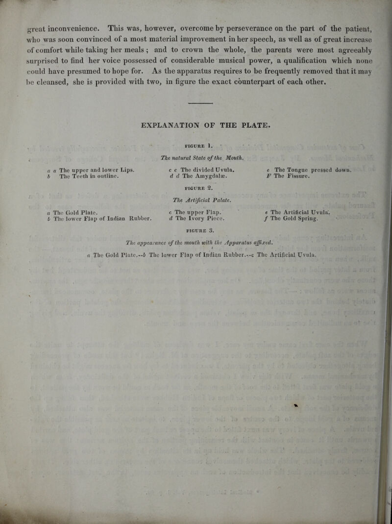 great inconvenience. This was, however, overcome by perseverance on the part of the patient, who was soon convinced of a most material improvement in her speech, as well as of great increase of comfort while taking her meals ; and to crown the whole, the parents were most agreeably surprised to find her voice possessed of considerable musical power, a qualification which none could have presumed to hope for. As the apparatus requires to be frequently removed that it may be cleansed, she is provided with two, in figure the exact counterpart of each other. EXPLANATION OF THE PLATE. FIGURE 1. The natural State of the Mouth. a a The upper and lower Lips. c c The divided Uvula. b The Teeth in outline. d d The Amygdalae. FIGURE 2. The Artificial Palate. a The Gold Plate. c The upper Flap. b The lower Flap of Indian Rubber. d The Ivory Piece. FIGURE 3. e The Tongue pressed down. F The Fissure. e The Artificial Uvula. f The Gold Spring. The appearance of the mouth with the Apparatus affixed. ) r. ■ a The Gold Plate.—& The lower Flap of Indian Rubber.—c The Artificial Uvula.