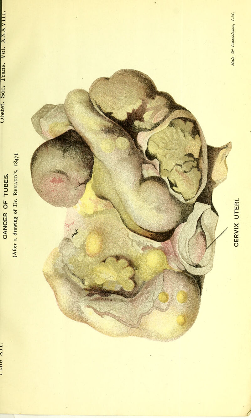 CANCER OF TUBES. (After a drawing of Dr. Renaud’s, 1847) / \ CERVIX UTERI