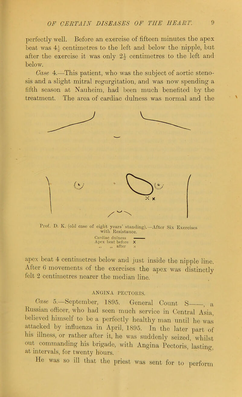 perfectly well. Before an exercise of fifteen minutes the apex beat was 4|- centimetres to the left and below the nipple, but after the exercise it was only 2| centimetres to the left and below. Case 4.—This patient, who was the subject of aortic steno- sis and a slight mitral regurgitation, and was now spending a fifth season at Nauheim, had been much benefited by the treatment. The area of cardiac dulness was normal and the X X Prof. D. K. (old case of eight years’ standing).—After Six Exercises with Resistance. Cardiac dulness —— Apex beat before X ,, ,, after x apex beat 4 centimetres below and just inside the nipple line. Alter 6 movements of the exercises the apex was distinctly felt 2 centimetres nearer the median line. ANGINA PECTOIU.S. Case 5.—September, 1895. General Count S , a Russian officer, who had seen much service in Central Asia, believed himself to be a perfectly healthy man until he was a^acked by influenza in April, 1895. In the later part of his illness, or rather after it, he was suddenly seized, whilst out commanding his brigade, with Angina Pectoris,’lasting at intervals, for twenty hours. He was so ill that the priest was sent for to perform