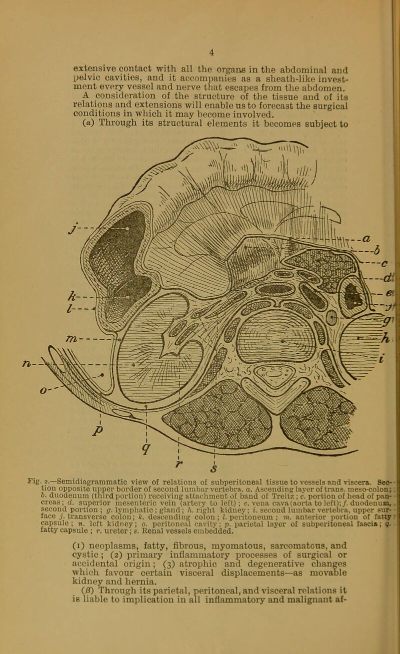 extensive contact with all the organs in the abdominal and pelvic cavities, and it accompanies as a sheath-like invest- ment every vessel and nerve that escapes from the abdomen. A consideration of the structure of the tissue and of its relations and extensions will enable us to forecast the surgical conditions in which it may become involved. (a) Through its structural elements it becomes subject to Fig. 2.—Semidiagrammatio view of relations of subperitoneal tissue to vessels and viscera. Sec- tion opposite upper border of second lumbar vertebra, a. Ascending layer of trans. meso-colon; b. duodenum (third portion) receiving attachment of baud of Trcilz ; c. portion of head of p.an- creas; d. superior mesenteric vein (artery to left); c. vena cava (aorta to left);/, duodenum, second portion ; g. lymphatic ; gland; h. right kidney; i. second lumbar vertebra, upper sur- face /.transverse colon; k. descending colon; (.peritoneum; m. anterior portion of fatty capsule ; n. left kidney; o. peritoneiu cavity; p. parietal layer of subperitoneal fascia; g. fatty capsule ; r. ureter; s. Renal vessels embedded. (i) neoplasms, fatty, fibrous, myomatous, sarcomatous, and cystic; (2) primary inflammatory processes of surgical or accidental origin; (3) atrophic and degenerative changes which favour certain visceral displacements—as movable kidney and hernia. Through its parietal, peritoneal, and visceral relations it is liable to implication in all inflammatory and malignant af-