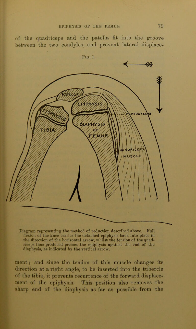 of the quadriceps and the patella fit into the groove between the two condyles, and prevent lateral displace- Fig. 1. m Diagram representing the method of reduction described above. Full flexion of the knee carries the detached epiphysis back into place in the direction of the horizontal arrow, whilst the tension of the quad- riceps thus produced presses the epiphysis against the end of the diaphysis, as indicated by the vertical arrow. ment; and since the tendon of this muscle changes its direction at a right angle, to be inserted into the tubercle of the tibia, it prevents recurrence of the forward displace- ment of the epiphysis. This position also removes the sharp end of the diaphysis as far as possible from the