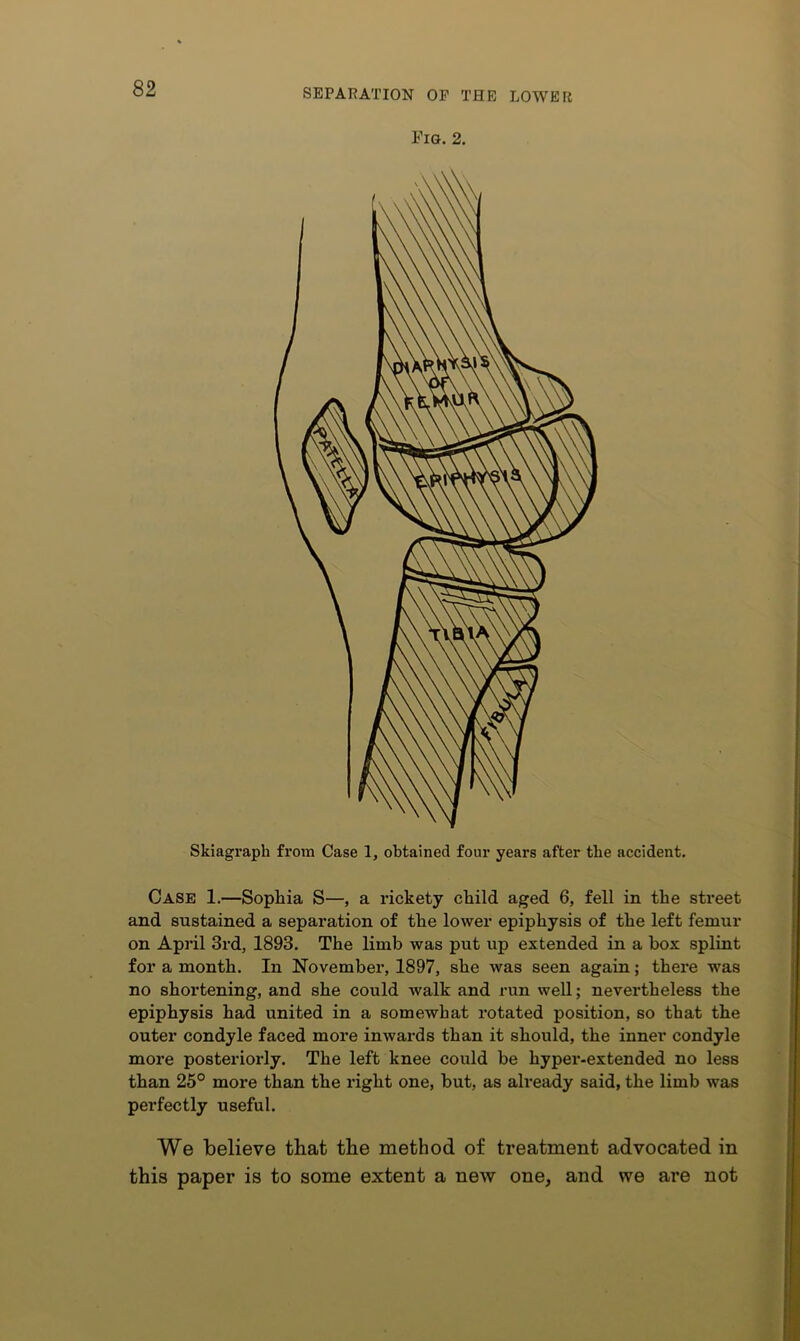 Fig. 2. Skiagraph from Case 1, obtained four years after the accident. Case 1.—Sophia S—, a rickety child aged 6, fell in the street and sustained a separation of the lower epiphysis of the left femur on April 3rd, 1893. The limb was put up extended in a box splint for a month. In November, 1897, she was seen again; there was no shortening, and she could walk and run well; nevertheless the epiphysis had united in a somewhat rotated position, so that the outer condyle faced more inwards than it should, the inner condyle more posteriorly. The left knee could be hyper-extended no less than 25° more than the right one, but, as already said, the limb was perfectly useful. We believe that the method of treatment advocated in this paper is to some extent a new one, and we are not