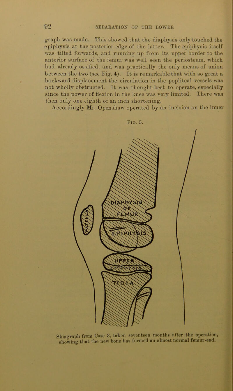 graph was made. This showed that the diaphysis only touched the epiphysis at the posterior edge of the latter. The epiphysis itself was tilted forwards, and running up from its upper border to the anterior surface of the femur was well seen the periosteum, which had already ossified, and was practically the only means of union between the two (see Fig. 4). It is re markable that with so great a backward displacement the circulation in the popliteal vessels was not Avholly obstructed. It was thought best to operate, especially since the power of flexion in the knee was very limited. There was then only one eighth of an inch shortening. Accordingly Mr. Openshaw operated by an incision on the inner Fig. 5. Skingraph from Case 3, taken seventeen months after the operation, showing that the new bone has formed an almost normal femur-end. i