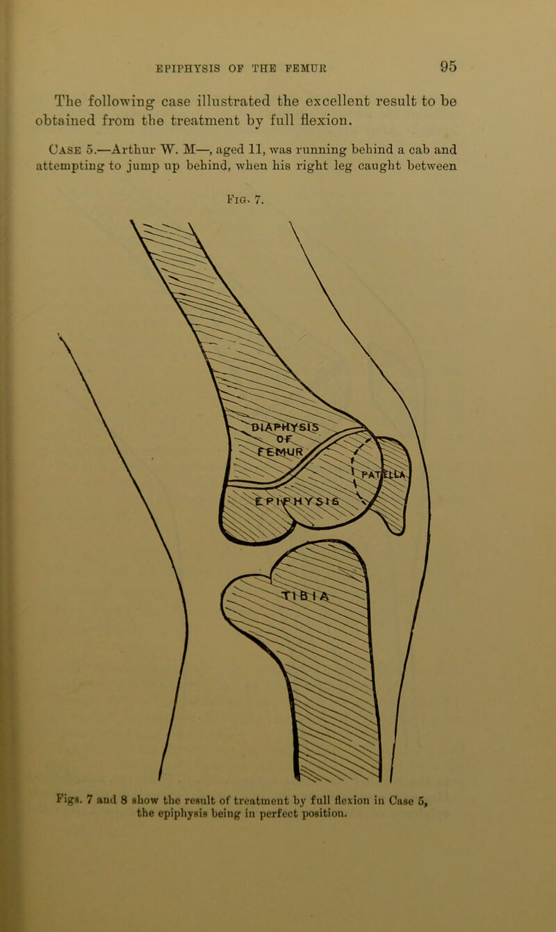 The following case illustrated the excellent result to be obtained from the treatment by full flexion. Case 5.—Arthur W. M—, aged 11, was running behind a cab and attempting to jump up behind, when his right leg caught between Fig. 7. Figs. 7 and 8 show the result of treatment by full flexion in Case 5, the epiphysis being in perfect jjosition.