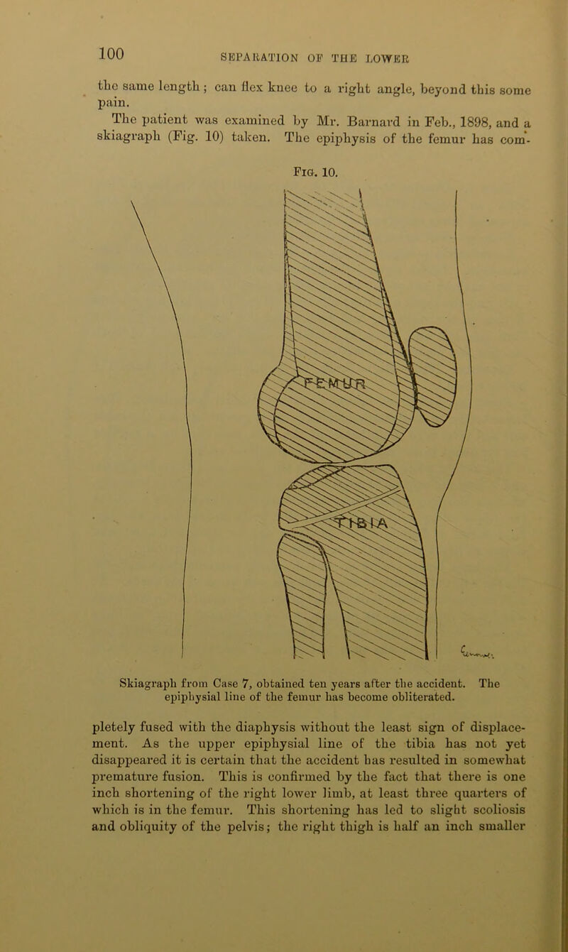 the same length ; can flex knee to a right angle, beyond this some pain. The patient was examined by Mr. Barnard in Feb., 1898, and a skiagraph (Fig. 10) taken. The epiphysis of the femur has com- Fia. 10. Skiagraph from Case 7, obtained ten years after the accident, epiphysial line of the femur has become obliterated. The pletely fused with the diaphysis without the least sign of displace- ment. As the upper epiphysial line of the tibia has not yet disappeai'ed it is certain that the accident has resulted in somewhat premature fusion. This is confirmed by the fact that there is one inch shortening of the right lower limb, at least three quarters of which is in the femur. This shortening has led to slight scoliosis and obliquity of the pelvis; the right thigh is half an inch smaller