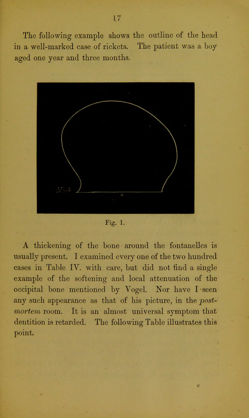 The following example shows the outline of the head in a well-marked case of rickets. The patient was a boy aged one year and three months. Fig. 1. A thickening of the bone around the fontanelles is usually present. I examined every one of the two hundred cases in Table IV. with care, but did not find a single example of the softening and local attenuation of the occipital bone mentioned by Vogel. Nor have I - seen any such appearance as that of his picture, in the post- mortem room. It is an almost universal symptom that dentition is retarded. The following Table illustrates this point.