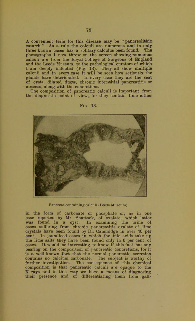 A convenient term for this disease may be “ pancreolithic catarrh.” As a rule the calculi are numerous and in only three known cases has a solitary calculus been found. The photographs 1 niw throw on the screen showing numerous calculi are from the Eoyal College of Surgeons of England and the Leeds Museum, to the pathological curators of which I am deeply indebted (Fig. 13). They all show multiple calculi and in every case it will be seen how seriously the glands have deteriorated. In every case they are the seat of cysts, dilated ducts, chronic interstitial pancreatitis or abscess, along with the concretions. The composition of pancreatic calculi is important from the diagnostic point of view,, for they contain lime either Fig. 13. Pancreas containing calculi (Leeds Museum). in the form of carbonate or phosphate or, as in one case reported by Mr. Shattock, of oxalale, which latter was found in a cyst. In examining the urine of cases suffering from chronic pancreatitis oxalate of lime crystals have been found by Dr. Oammidge in over 40 per cent. In jaundiced cases in which the bile acids take up the lime salts they have been found only in 6 per cent, of cases. It would be interesting to know if this fact has any bearing on the composition of pancreatic concretions, for it is a well-known fact that the normal pancreatic secretion contains no calcium carbonate. The subject is worthy of further investigation. The consequence of this chemical composition is that pancreatic calculi are opaque to the X rays and in this way we have a means of diagnosing their presence and of differentiating them from gall-