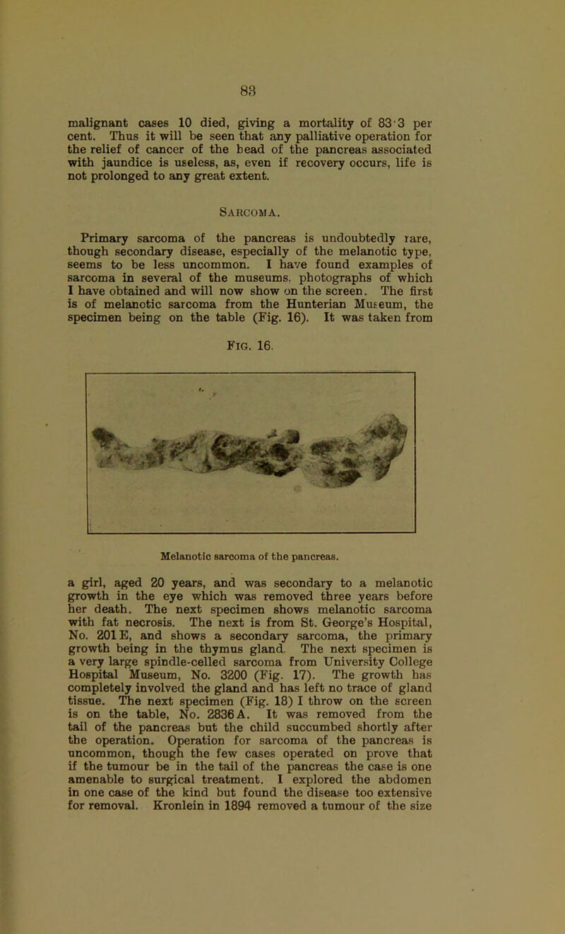 malignant cases 10 died, giving a mortality of 83'3 per cent. Thus it will be seen that any palliative operation for the relief of cancer of the head of the pancreas associated with jaundice is useless, as, even if recovery occurs, life is not prolonged to any great extent. Sarcoma. Primary sarcoma of the pancreas is undoubtedly rare, though secondary disease, especially of the melanotic type, seems to be less uncommon. I have found examples of sarcoma in several of the museums, photographs of which I have obtained and will now show on the screen. The first is of melanotic sarcoma from the Hunterian Museum, the specimen being on the table (Fig. 16). It was taken from Fig. 16. Melanotic sarcoma of the pancreas. a girl, aged 20 years, and was secondary to a melanotic growth in the eye which was removed three years before her death. The next specimen shows melanotic sarcoma with fat necrosis. The next is from St. George’s Hospital, No. 201E, and shows a secondary sarcoma, the primary growth being in the thymus gland. The next specimen is a very large spindle-celled sarcoma from University College Hospital Museum, No. 3200 (Fig. 17). The growth has completely involved the gland and has left no trace of gland tissue. The next specimen (Fig. 18) I throw on the screen is on the table. No. 2836 A. It was removed from the tail of the pancreas but the child succumbed shortly after the operation. Operation for sarcoma of the pancreas is uncommon, though the few cases operated on prove that if the tumour be in the tail of the pancreas the case is one amenable to surgical treatment. I explored the abdomen in one case of the kind but found the disease too extensive for removal. Eronlein in 1894 removed a tumour of the size