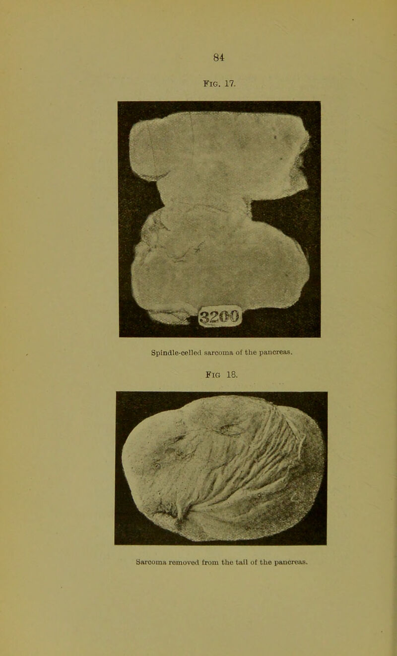 Fig. 17. Spindle-celled sarcoma of the pancreas. Fig 18. Sarcoma removed from the tail of the pancreas.