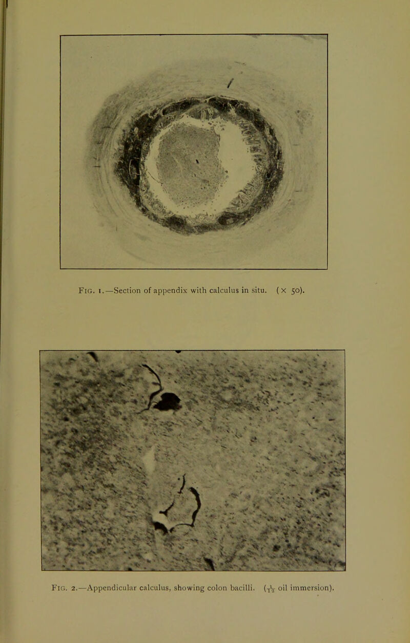 Fig. 2.—Appendicular calculus, showing colon bacilli, (.j'j- oil immersion)