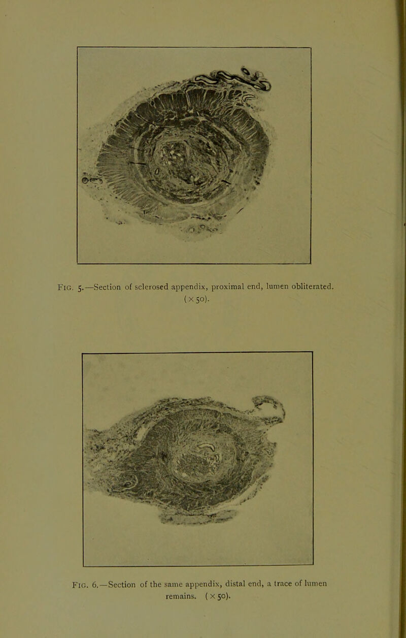 Fig. 5.—Section of sclerosed appendix, proximal end, lumen obliterated. (X50). Fig. 6.—Section of the same appendix, distal end, a trace of lumen