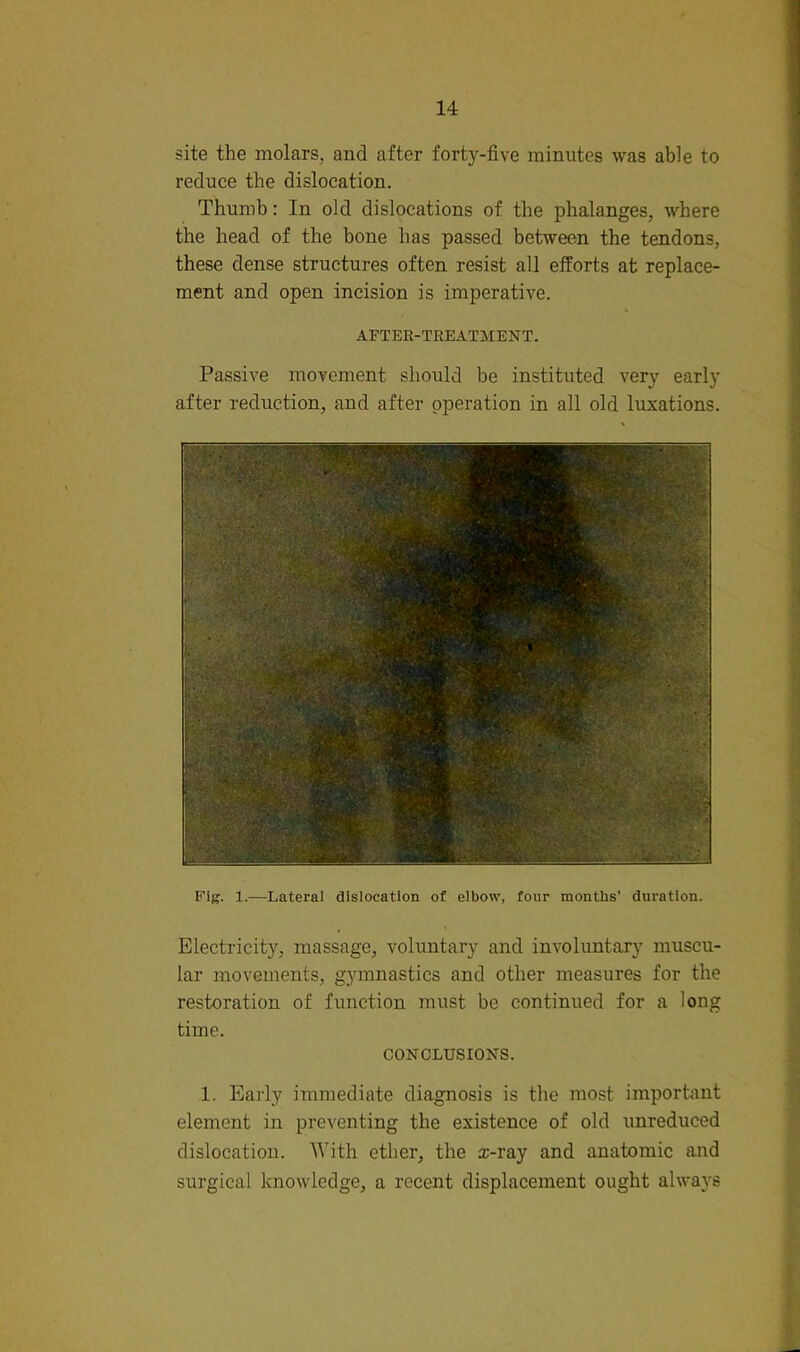 site the molars, and after forty-five minutes was able to reduce the dislocation. Thumb: In old dislocations of the phalanges, where the head of the bone has passed between the tendons, these dense structures often resist all efforts at replace- ment and open incision is imperative. AFTER-TREATMENT. Passive movement should be instituted very early after reduction, and after operation in all old luxations. Fijj. 1.—Lateral dislocation of elbow, four months’ duration. Electricity, massage, voluntary and involuntary muscu- lar movements, gymnastics and other measures for the restoration of function must be continued for a long time. CONCLUSIONS. 1. Early immediate diagnosis is the most important element in preventing the existence of old unreduced dislocation. With ether, the x-ray and anatomic and surgical knowledge, a recent displacement ought always