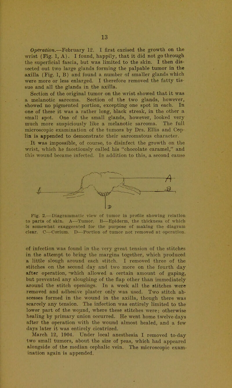 Operation.—February 12. I first excised the growth on the wrist (Fig. 1, A). I found, happily, that it did not go through the superficial fascia, but was limited to the skin. I then dis- sected out two large glands forming the palpable tumor in the axilla (Fig. 1, B) and found a number of smaller glands which were more or less enlarged. I therefore removed the fatty tis- sue and all the glands in the axilla. Section of the original tumor on the wrist showed that it was a melanotic sarcoma. Section of the two glands, however, showed no pigmented portion, excepting one spot in each. In one of these it was a rather long, black streak, in the other a small spot. One of the small glands, however, looked very much more suspiciously like a melanotic sarcoma. The full microscopic examination of the tumors by Drs. Ellis and Cop- lin is appended to demonstrate their sarcomatous character. It was impossible, of course, to disinfect the growth on the wrist, which he facetiously called his “chocolate caramel,” and this wound became infected. In addition to this, a second cause Fig. 2.—Diagrammatic view of tumor in profile showing relation to parts of skin. A—Tumor. li—Epiderm, the thickness of which is somewhat exaggerated for the purpose of making the diagram clear. C—Corium. D—Portion of tumor not removed at operation. of infection was found in the very great tension of the stitches in the attempt to bring the margins together, which produced a little slough around each stitch. I removed three of the stitches on the second day and two more on the fourth day after operation, ‘which allowed a certain amount of gaping, but prevented any sloughing of the flap other than immediately around the stitch openings. In a week all the stitches were removed and adhesive plaster only was used. Two stitch ab- scesses formed in the wound in the axilla, though there was scarcely any tension. The infection was entirely limited to the lower part of the wo;ind, where these stitches were; otherwise healing by primary union occurred. He went home twelve days after the operation with the wound almost healed, and a few days later it was entirely cicatrized. March 12, 1904. Under local anesthesia I removed to-day two small tumors, about the size of peas, which had appeared alongside of the median cephalic vein. The microscopic exam- ination again is appended.