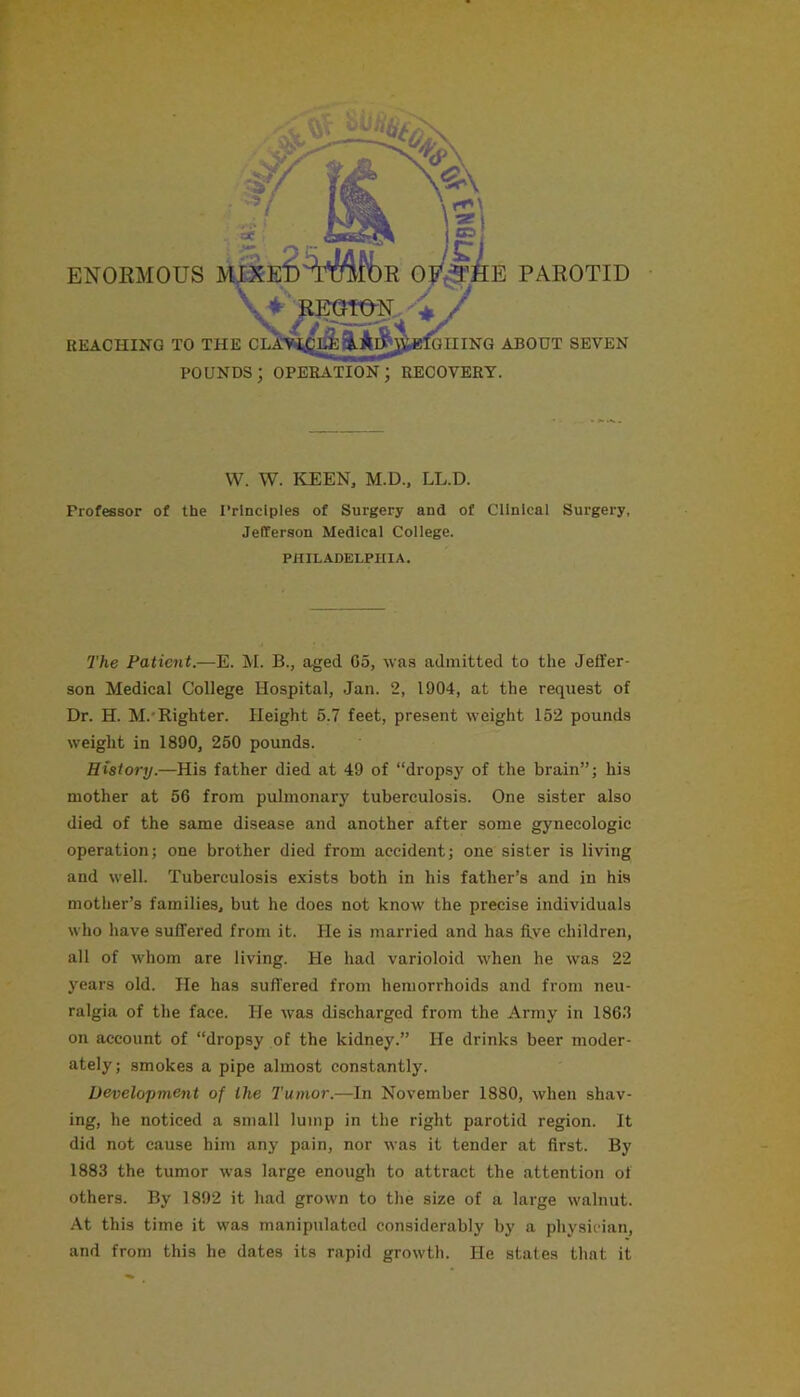 ENORMOUS REACHING TO THE CLA E PAROTID GHING ABOUT SEVEN pounds; operation; recovery. W. W. KEEN, M.D., LL.D. Professor of the I’rlnclples of Surgery and of Clinical Surgery, Jefferson Medical College. PIIILADELPIIIA. The Patient.—E. M. B., aged 65, was admitted to the Jeffer- son Medical College Hospital, Jan. 2, 1904, at the request of Dr. H. M.'Righter. Height 5.7 feet, present weight 152 pounds weight in 1890, 250 pounds. History.—His father died at 49 of “dropsy of the brain”; his mother at 56 from pulmonary tuberculosis. One sister also died of the same disease and another after some gynecologic operation; one brother died from accident; one sister is living and well. Tuberculosis exists both in his father’s and in his mother’s families, but he does not know the precise individuals who have suffered from it. He is married and has five children, all of whom are living. He had varioloid when he was 22 years old. He has suffered from hemorrhoids and from neu- ralgia of the face. He was discharged from the Army in ISe.T on account of “dropsy of the kidney.” He drinks beer moder- ately; smokes a pipe almost constantly. Development of the Tumor.—In November 1880, when shav- ing, he noticed a small lump in the right parotid region. It did not cause him any pain, nor was it tender at first. By 1883 the tumor was large enough to attract the attention of others. By 1892 it had grown to the size of a large walnut. At this time it was manipulated considerably by a physician, and from this he dates its rapid growth. He states that it