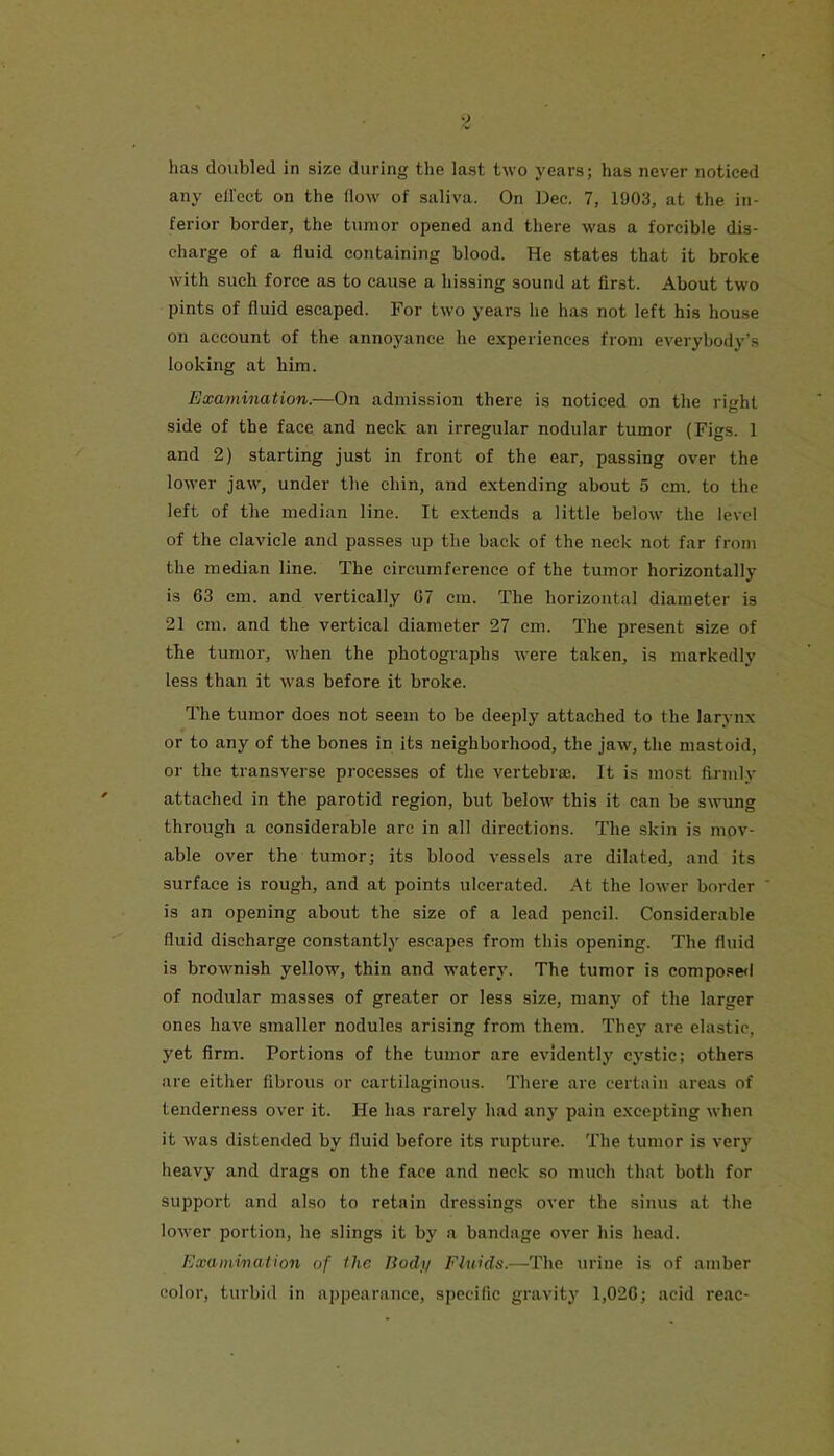 has doubled in size during the last two years; has never noticed any ell’cct on the flow of saliva. On Dec. 7, 1903, at the in- ferior border, the tumor opened and there was a forcible dis- charge of a fluid containing blood. He states that it broke with such force as to cause a hissing sound at first. About two pints of fluid escaped. For two years he has not left his house on account of the annoyance he experiences from everybody’s looking at him. Examination.—On admission there is noticed on the right side of the face and neck an irregular nodular tumor (Figs. 1 and 2) starting just in front of the ear, passing over the lower jaw, under the chin, and extending about 5 cm. to the left of the median line. It extends a little below the level of the clavicle and passes up the back of the neck not far from the median line. The circumference of the tumor horizontally is 63 cm. and vertically 67 cm. The horizontal diameter is 21 cm. and the vertical diameter 27 cm. The present size of the tumor, when the photographs were taken, is markedly less than it was before it broke. The tumor does not seem to be deeply attached to the larynx or to any of the bones in its neighborhood, the jaw, the mastoid, or the transverse processes of the vertebrae. It is most ftrmly attached in the parotid region, but below this it can be swung through a considerable arc in all directions. The skin is mov- able over the tumor; its blood vessels are dilated, and its surface is rough, and at points ulcerated. At the lower border ' is an opening about the size of a lead pencil. Considerable fluid discharge constantly escapes from this opening. The fluid is brownish yellow, thin and watery. The tumor is compo.^e*! of nodular masses of greater or less size, many of the larger ones have smaller nodules arising from them. They are elastic, yet firm. Portions of the tumor are evidently cystic; others are either fibrous or cartilaginous. There are certain areas of tenderness over it. He has rarely had any pain excepting when it was distended by fluid before its rupture. The tumor is very heavy and drags on the face and neck so much that both for support and also to retain dressings over the sinus at the loM-er portion, he slings it by a bandage over his head. Examination of the Itodii Fluids.—The urine is of amber color, turbid in appearance, specific gravitj' 1,026; acid reac-