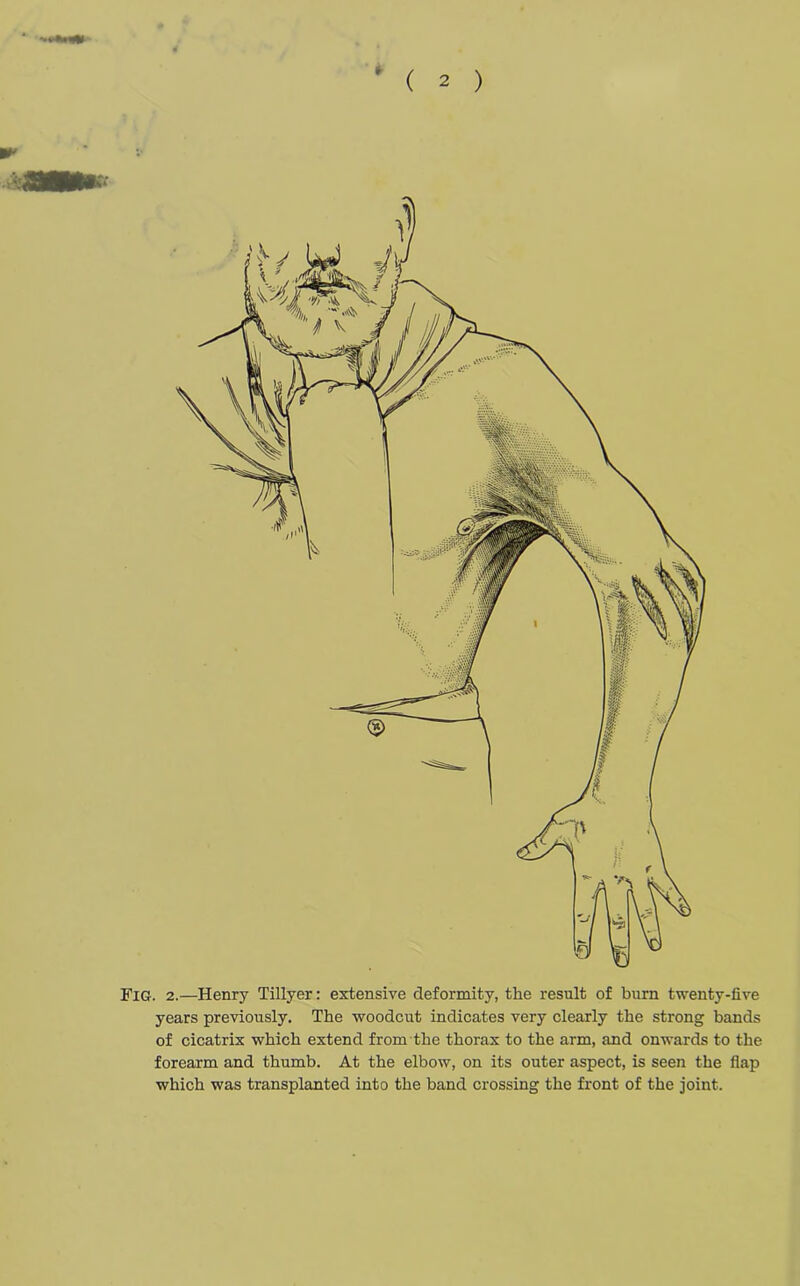 *■ Fig. 2.—Henry Tillyer: extensive deformity, the result of burn twenty-five years previously. The woodcut indicates very clearly the strong bands of cicatrix which extend from the thorax to the arm, and onwards to the forearm and thumb. At the elbow, on its outer aspect, is seen the flap which was transplanted into the band crossing the front of the joint.