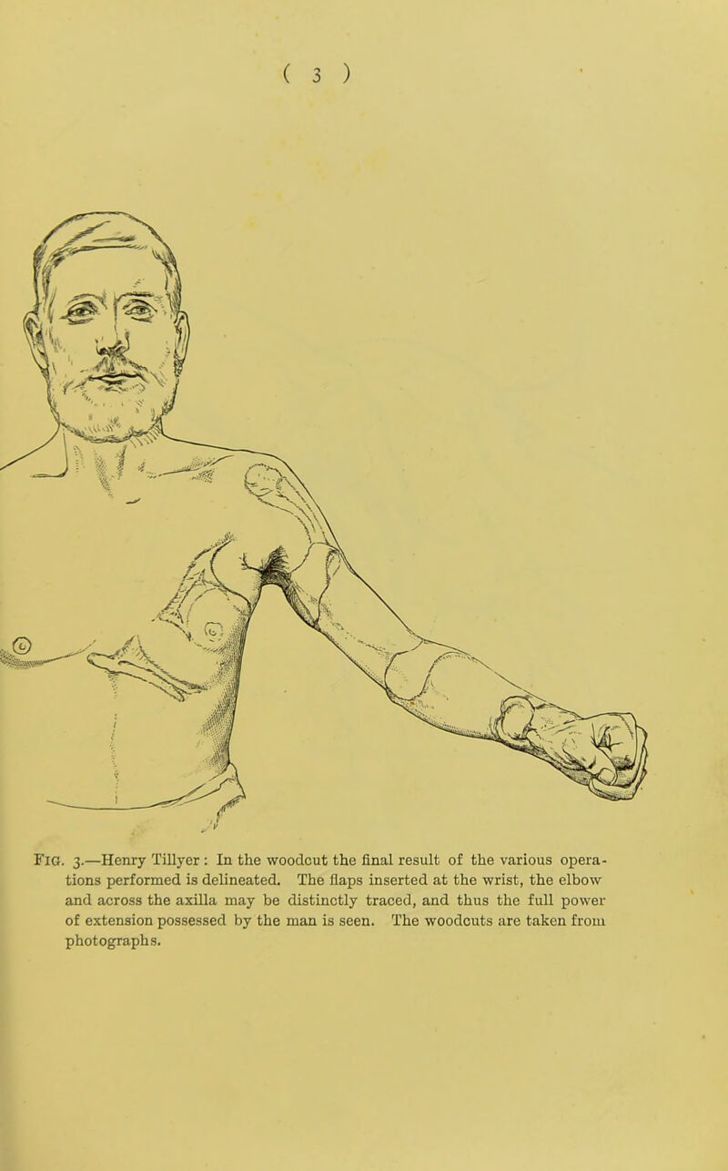 Fig. 3.—Henry Tillyer : In the woodcut the final result of the various opera- tions performed is delineated. The flaps inserted at the wrist, the elbow and across the axilla may be distinctly traced, and thus the full power of extension possessed by the man is seen. The woodcuts are taken from photographs.