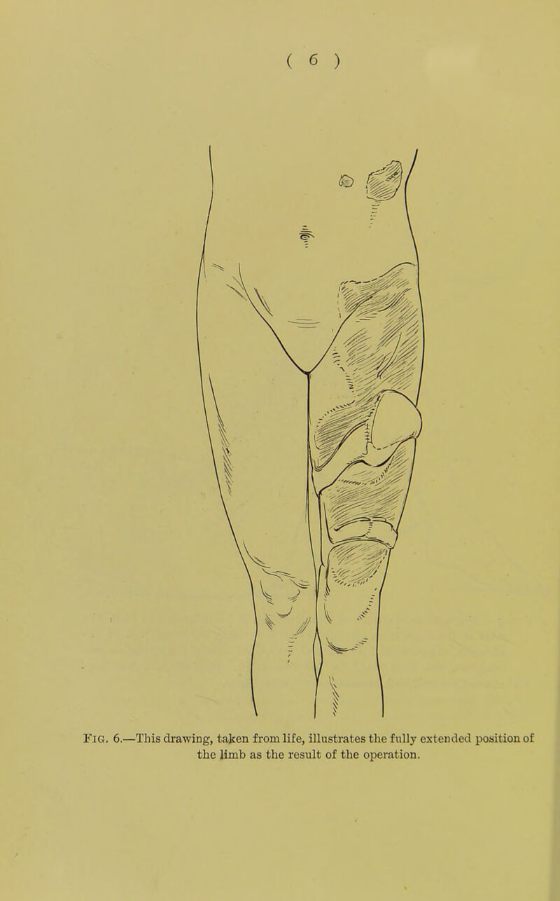 Fig. 6.—This drawing, taken from life, illustrates the fully extended position of the limb as the result of the operation.