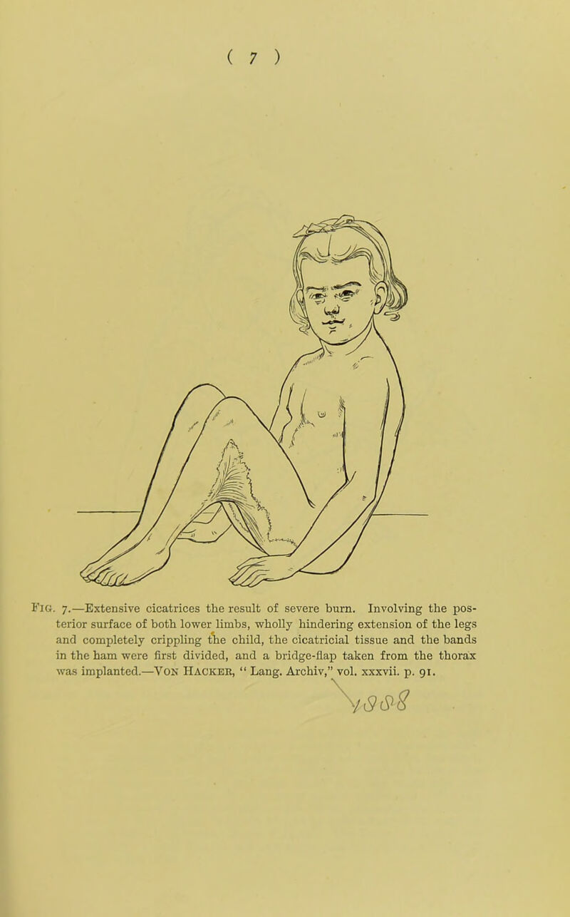 Fig. 7.—Extensive cicatrices the result of severe burn. Involving the pos- terior surface of both lower limbs, wholly hindering extension of the legs and completely crippling the child, the cicatricial tissue and the bands in the ham were first divided, and a bridge-fiap taken from the thorax was implanted.—Von Hackee, “ Lang. Archiv,” vol. xxxvii. p. 91.