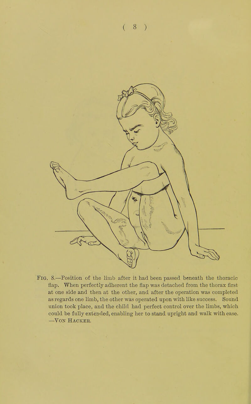 ( 3 ) Fig. 8.—Position of the limb after it had been passed beneath the thoracic flap. When perfectly adherent the flap was detached from the thorax first at one side and then at the other, and after the operation was completed as regards one limb, the other was operated upon with like success. Sound union took place, and the child had perfect control over the limbs, which could be fully extended, enabling her to stand upright and walk with ease. —Von Hackee.