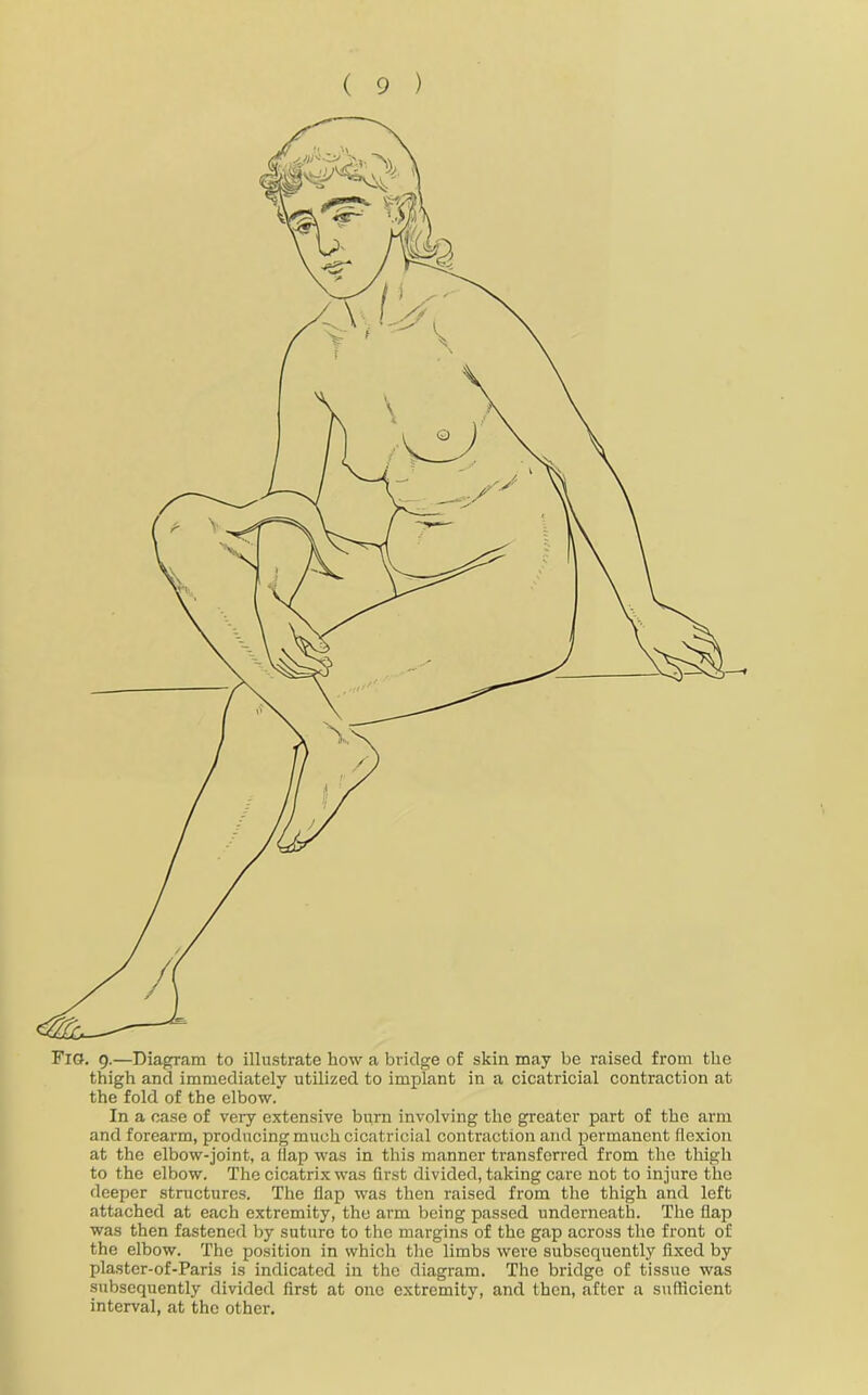 Fig. 9.—Diagram to illustrate how a bridge of skin may be raised from the thigh and immediately utilized to implant in a cicatricial contraction at the fold of the elbow. In a case of very extensive burn involving the greater part of the arm and forearm, producing much cicatricial contraction and permanent flexion at the elbow-joint, a flap was in this manner transferred from the thigh to the elbow. The cicatrix was first divided, taking care not to injure the deeper structures. The flap was then raised from the thigh and left attached at each extremity, the arm being passed underneath. The flap was then fastened by suture to the margins of the gap across the front of the elbow. The position in which the limbs were subsequently fixed by plaster-of-Paris is indicated in the diagram. The bridge of tissue was subsequently divided first at one extremity, and then, after a sufficient interval, at the other.