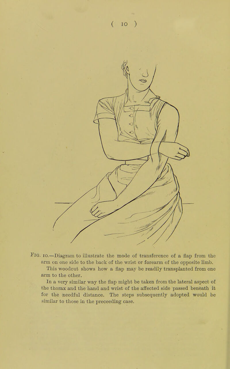 IiG. io.—Diagram to illustrate the mode of transference of a flap from the arm on one side to the back of the wrist or forearm of the opposite limb. This woodcut shows how a flap may be readily transplanted from one arm to the other. In a very similar way the flap might be taken from the lateral aspect of the thorax and the hand and wrist of the affected side passed beneath it for the needful distance. The steps subsequently adopted would be similar to those in the preceeding case.