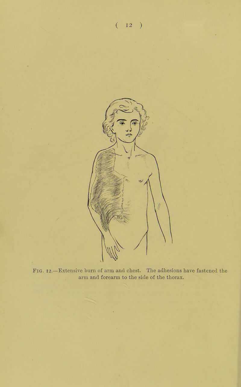 Fig. 12.—Extensive burn of arm and chest. The adhesions have fastened the arm and forearm to the side of the thorax.