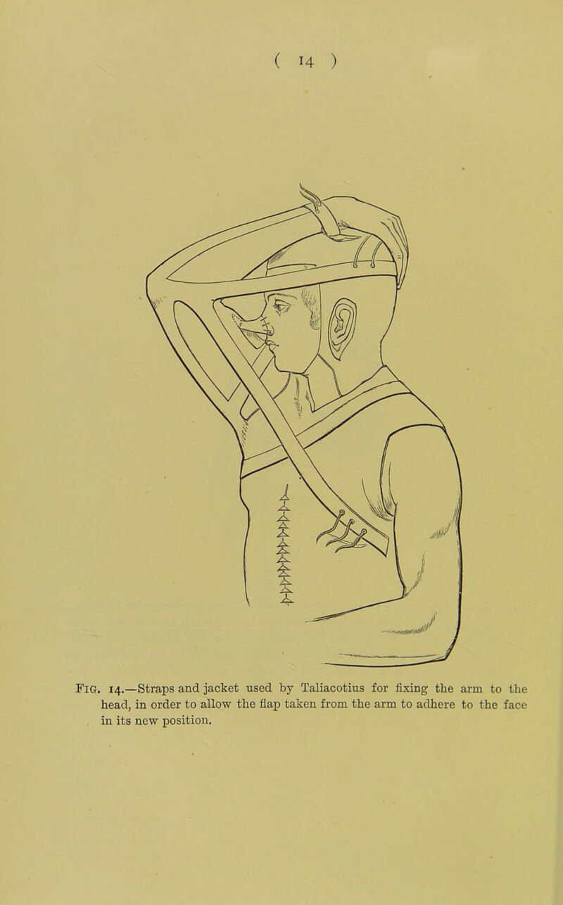 Fig. 14.—Straps and jacket used by Taliacotius for fixing the arm to the head, in order to allow the flap taken from the arm to adhere to the face in its new position.