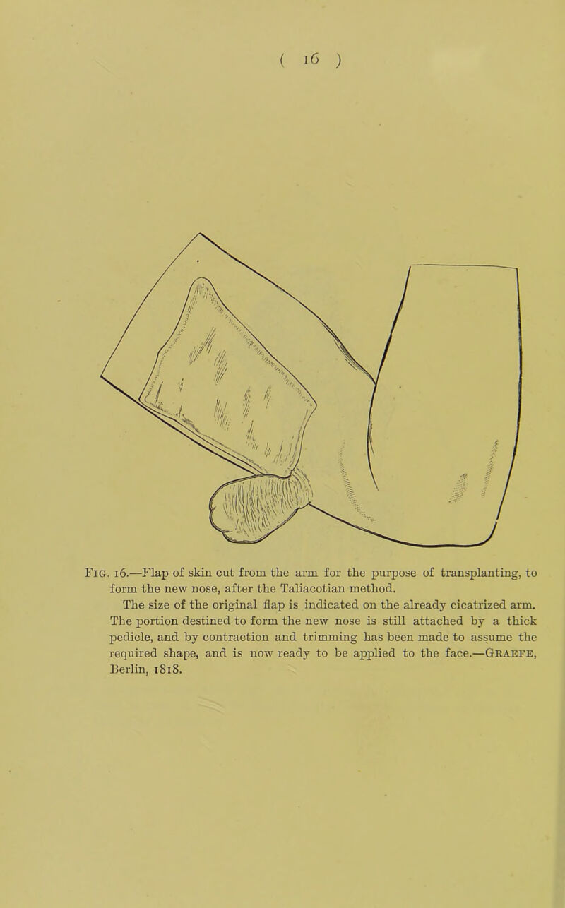 ( i <3 ) Fig. 16.—Flap of skin cut from the arm for the purpose of transplanting, to form the new nose, after the Taliacotian method. The size of the original flap is indicated on the already cicatrized arm. The portion destined to form the new nose is still attached by a thick pedicle, and by contraction and trimming has been made to assume the required shape, and is now ready to be applied to the face.—Gkaefe, Uerlin, 1818.