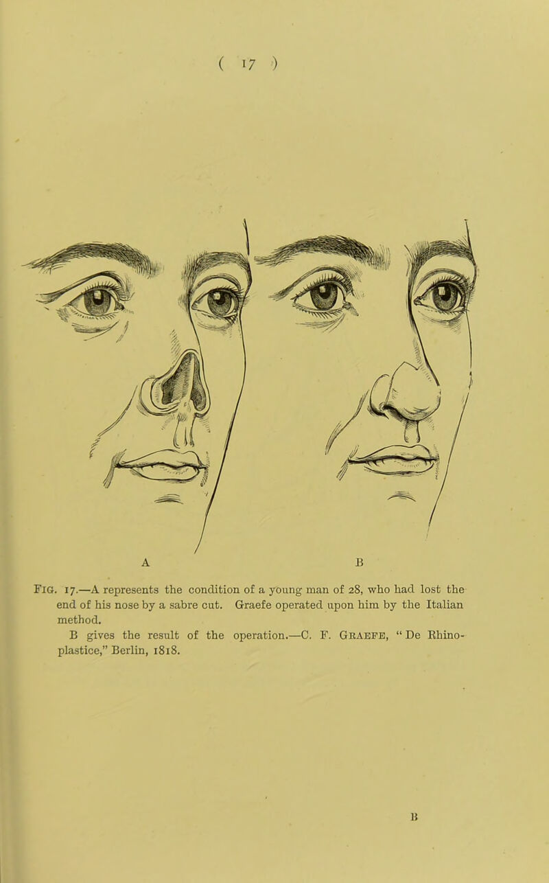 Fig. 17.—A represents the condition of a young man of 28, who had lost the end of his nose by a sabre cut. Graefe operated upon him by the Italian method. B gives the result of the operation.—C. F. Gkaefe, “ De Rhino- plastice,” Berlin, 1818. B