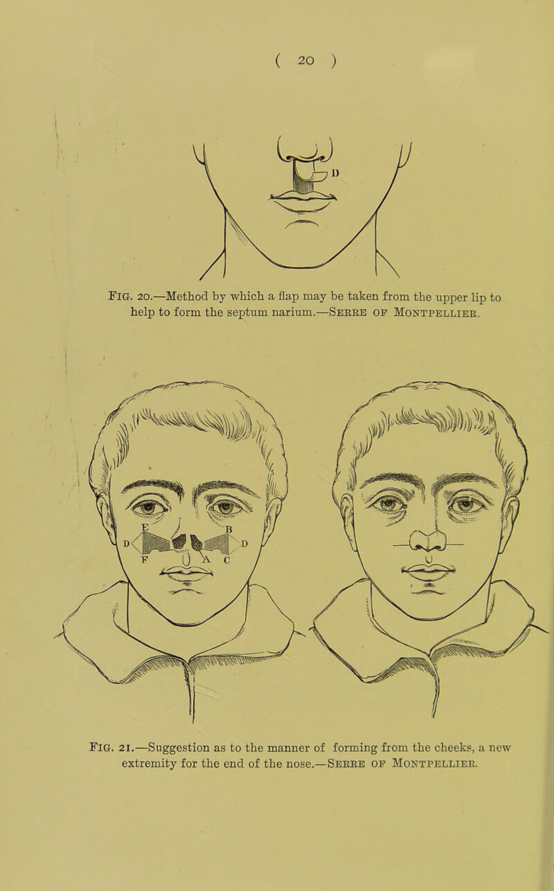 FIG. 20.—Method by which a flap may be taken from the upper lip to help to form the septum narium.—Serbs op Montpellier. Fig. 21.—Suggestion as to the manner of forming from the cheeks, a new extremity for the end of the nose.—Serre op Montpellier.