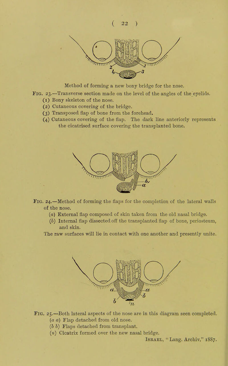 Method of forming a new bony bridge for the nose. Fig. 23.—Transverse section made on the level of the angles of the eyelids. (1) Bony skeleton of the nose. (2) Cutaneous covering of the bridge. (3) Transposed flap of bone from the forehead. (4) Cutaneous covering of the flap. The dark line anteriorly represents the cicatrised surface covering the transplanted bone. Fig. 24.—Method of forming the flaps for the completion of the lateral walls of the nose. (a) External flap composed of skin taken from the old nasal bridge. (ib) Internal flap dissected off the transplanted flap of bone, periosteum, and skin. The raw surfaces will lie in contact with one another and presently unite. Fig. 25.—Both lateral aspects of the nose are in this diagram seen completed. (a a) Flap detached from old nose. (b b) Flaps detached from transplant. (n) Cicatrix formed over the new nasal bridge. Israel, “Lang. Archiv,” 1SS7.