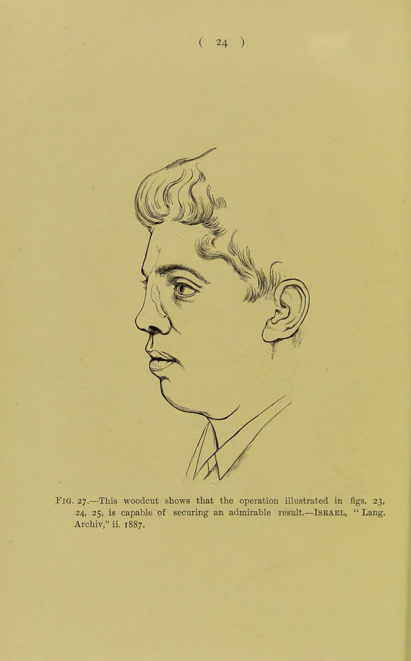 Fig. 27.—This woodcut shows that the operation illustrated in figs. 23, 24, 25, is capable of securing an admirable result.—ISRAEL, “ Lang. Archiv,” ii. 1887.
