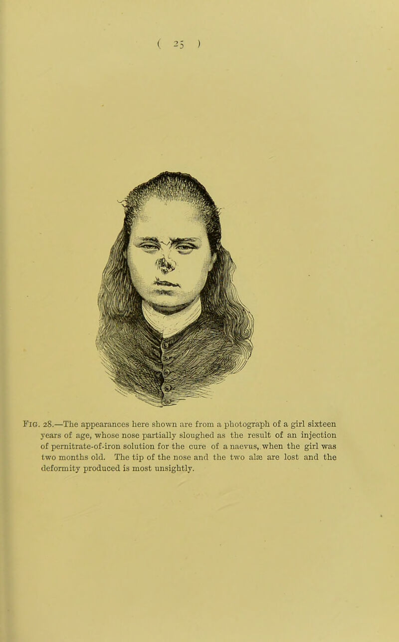 Fig. 28.—The appearances here shown are from a photograph of a girl sixteen years of age, whose nose partially sloughed as the result of an injection of pernitrate-of-iron solution for the cure of a naevus, when the girl was two months old. The tip of the nose and the two alee are lost and the deformity produced is most unsightly.