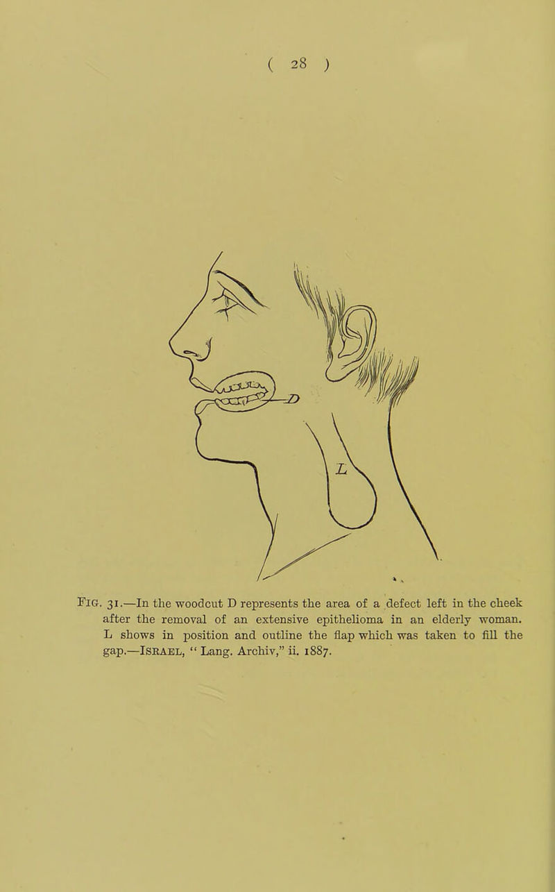 Fig. 31.—In the woodcut D represents the area of a defect left in the cheek after the removal of an extensive epithelioma in an elderly woman. L shows in position and outline the flap which was taken to fill the gap.—Israel, “ Lang. Archiv,” ii. 1887.